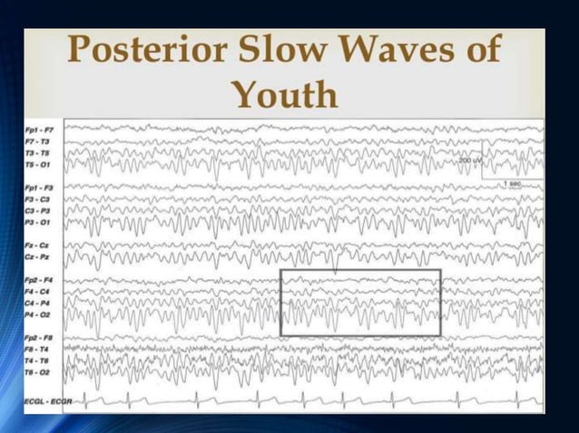 EEG of Children and Sleep | PPTX | Parenting Babies and Toddlers ...