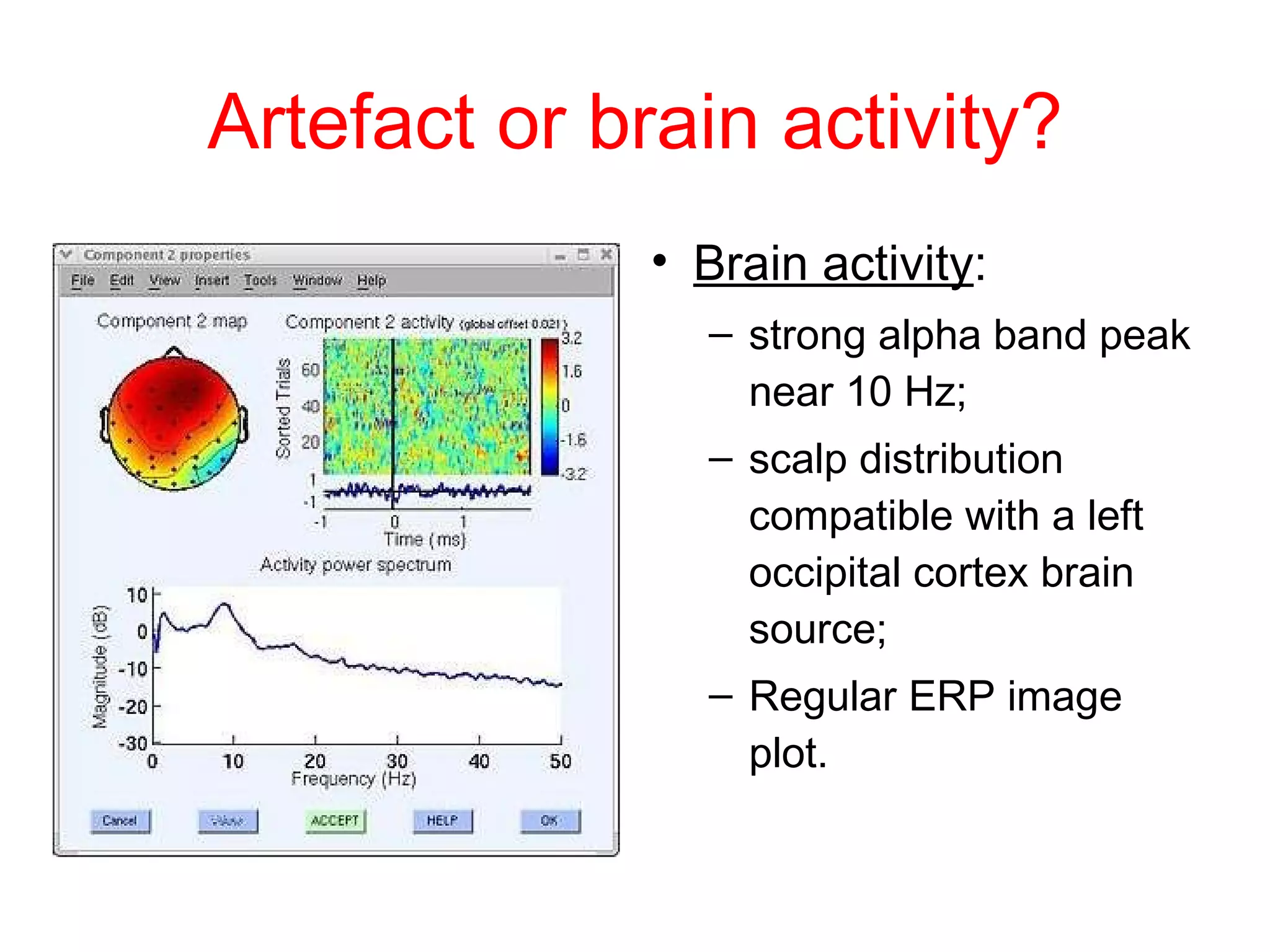 EEG artefacts | PPT | Brain and Nervous System Disorders | Diseases and ...