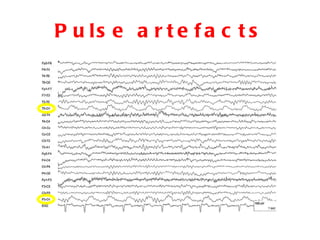 Pulse artefacts 