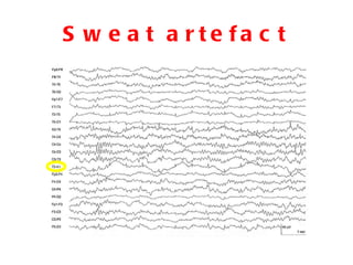 Sweat artefact 