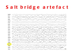 Salt bridge artefact 