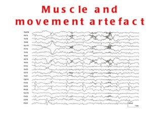Muscle and movement artefact 