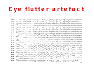 Eye flutter artefact 
