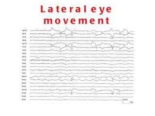 Lateral eye movement 