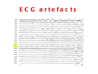 ECG artefacts 