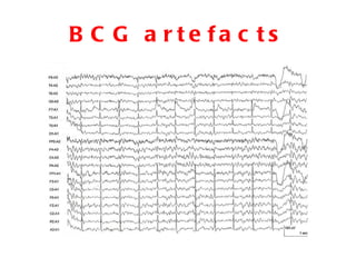 BCG artefacts 