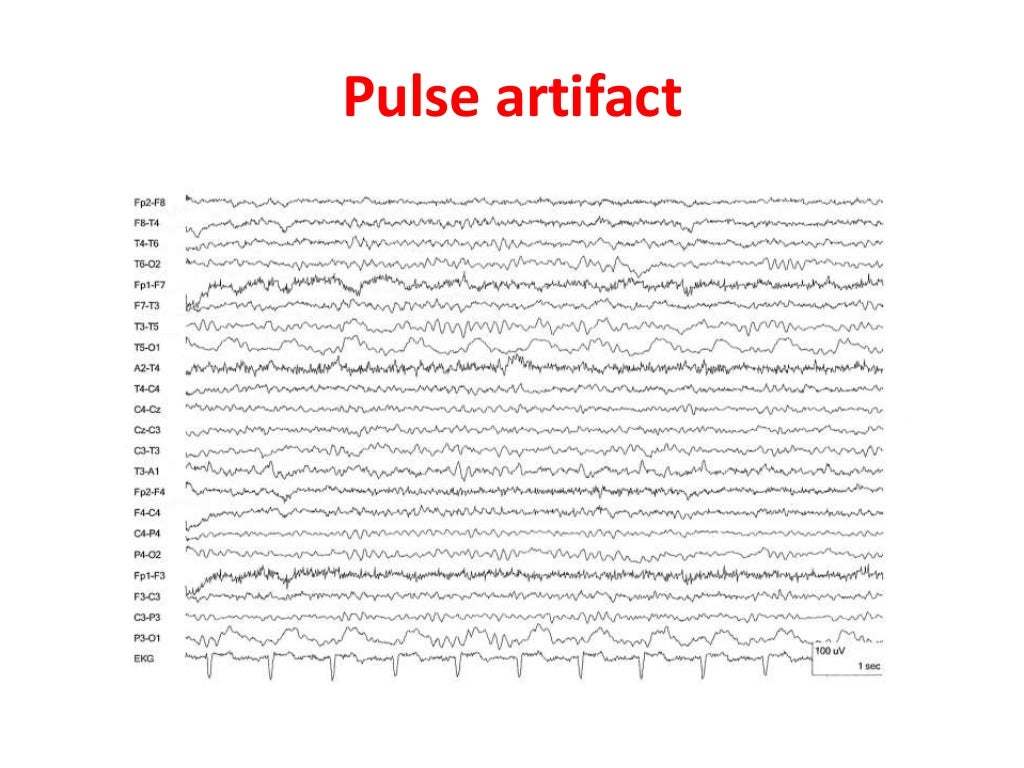 EEG Artifacts