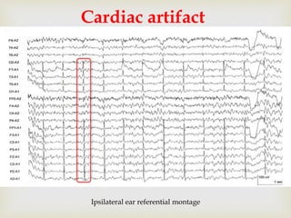 
Cardiac artifact
Ipsilateral ear referential montage
 