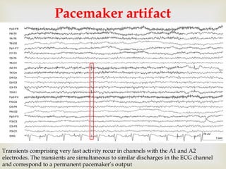 
Pacemaker artifact
Transients comprising very fast activity recur in channels with the A1 and A2
electrodes. The transients are simultaneous to similar discharges in the ECG channel
and correspond to a permanent pacemaker’s output
 