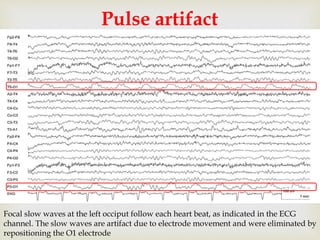 
Pulse artifact
Focal slow waves at the left occiput follow each heart beat, as indicated in the ECG
channel. The slow waves are artifact due to electrode movement and were eliminated by
repositioning the O1 electrode
 