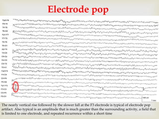 
Electrode pop
The nearly vertical rise followed by the slower fall at the F3 electrode is typical of electrode pop
artifact. Also typical is an amplitude that is much greater than the surrounding activity, a field that
is limited to one electrode, and repeated recurrence within a short time
 