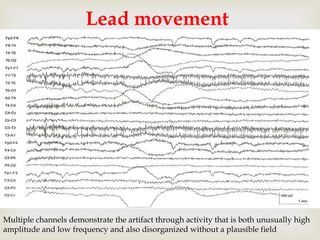 
Lead movement
Multiple channels demonstrate the artifact through activity that is both unusually high
amplitude and low frequency and also disorganized without a plausible field
 