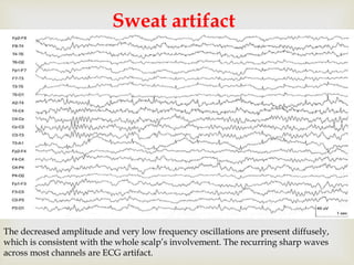 
Sweat artifact
The decreased amplitude and very low frequency oscillations are present diffusely,
which is consistent with the whole scalp’s involvement. The recurring sharp waves
across most channels are ECG artifact.
 