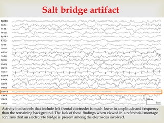 
Salt bridge artifact
Activity in channels that include left frontal electrodes is much lower in amplitude and frequency
than the remaining background. The lack of these findings when viewed in a referential montage
confirms that an electrolyte bridge is present among the electrodes involved.
 