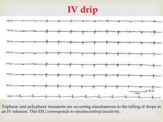 
IV drip
Triphasic and polyphasic transients are occurring simultaneous to the falling of drops in
an IV infusion. This EEG corresponds to electrocerebral inactivity.
 