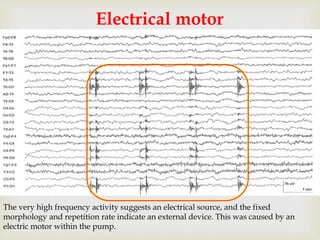 
Electrical motor
The very high frequency activity suggests an electrical source, and the fixed
morphology and repetition rate indicate an external device. This was caused by an
electric motor within the pump.
 