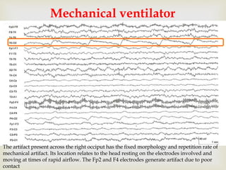 
Mechanical ventilator
The artifact present across the right occiput has the fixed morphology and repetition rate of
mechanical artifact. Its location relates to the head resting on the electrodes involved and
moving at times of rapid airflow. The Fp2 and F4 electrodes generate artifact due to poor
contact
 