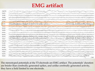 
EMG artifact
The stereotyped potentials at the T3 electrode are EMG artifact. The potentials’ duration
are briefer than cerebrally generated spikes, and unlike cerebrally generated activity,
they have a field limited to one electrode.
 