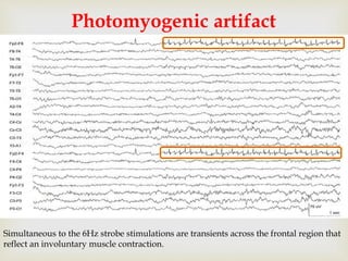 
Photomyogenic artifact
Simultaneous to the 6Hz strobe stimulations are transients across the frontal region that
reflect an involuntary muscle contraction.
 