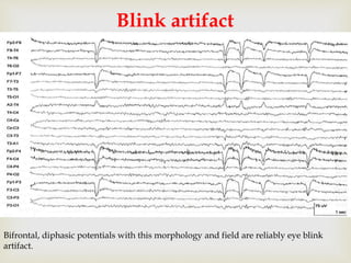 
Blink artifact
Bifrontal, diphasic potentials with this morphology and field are reliably eye blink
artifact.
 