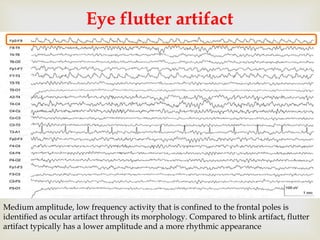 
Eye flutter artifact
Medium amplitude, low frequency activity that is confined to the frontal poles is
identified as ocular artifact through its morphology. Compared to blink artifact, flutter
artifact typically has a lower amplitude and a more rhythmic appearance
 