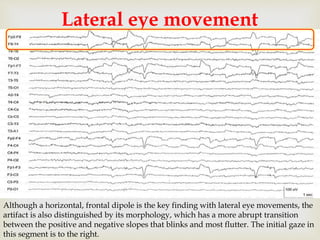 
Lateral eye movement
Although a horizontal, frontal dipole is the key finding with lateral eye movements, the
artifact is also distinguished by its morphology, which has a more abrupt transition
between the positive and negative slopes that blinks and most flutter. The initial gaze in
this segment is to the right.
 
