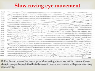 
Slow roving eye movement
Unlike the saccades of the lateral gaze, slow roving movement artifact does not have
abrupt changes. Instead, it reflects the smooth lateral movements with phase reversing
slow activity.
 