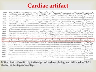 
Cardiac artifact
ECG artifact is identified by its fixed period and morphology and is limited to T3-A1
channel in this bipolar montage
 