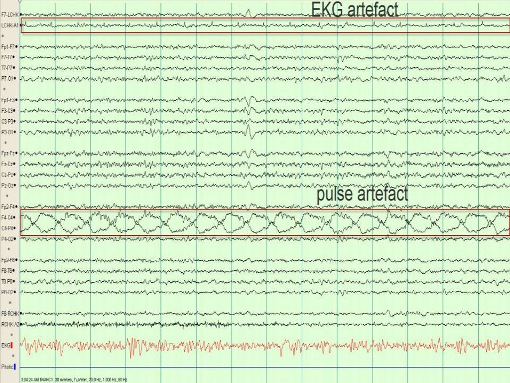EEG artifacts