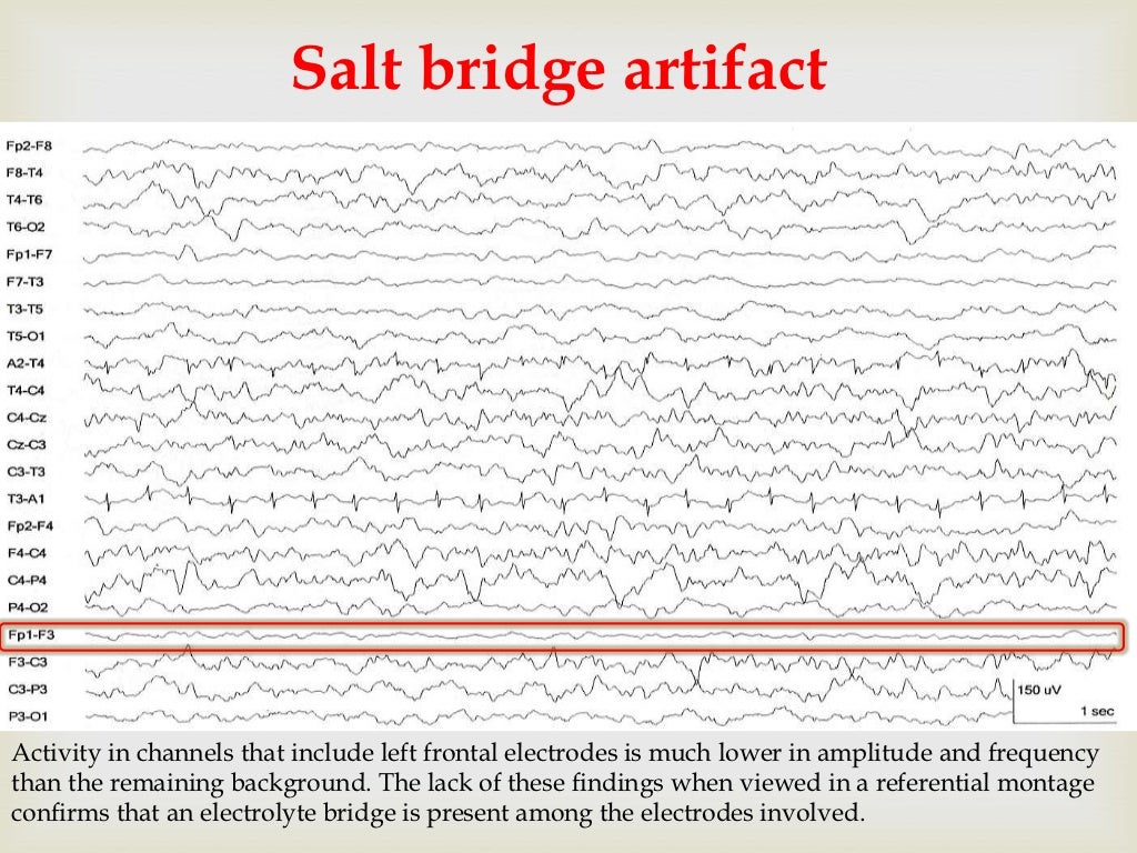 EEG artifacts