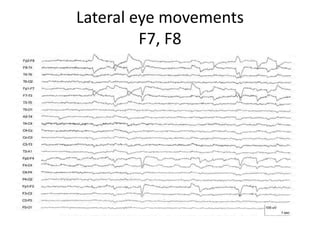 Lateral eye movements
F7, F8
 