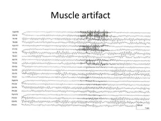 Muscle artifact
 