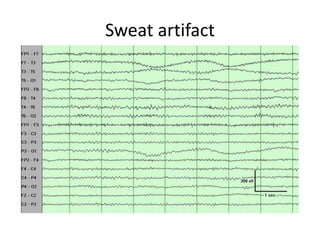 Sweat artifact
 