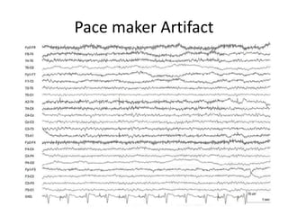 Pace maker Artifact
 