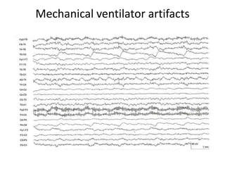 Mechanical ventilator artifacts
 