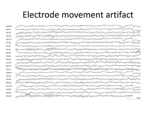 Electrode movement artifact
 