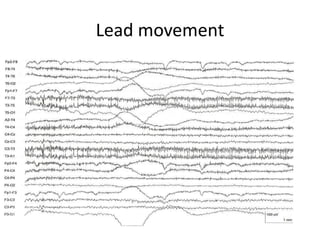 Lead movement
 