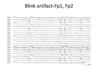 Blink artifact-Fp1, Fp2
 