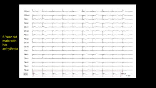 5 Year old
male with
h/o
arrhythmia
 