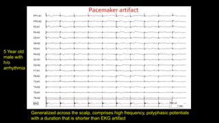Generalized across the scalp, comprises high frequency, polyphasic potentials
with a duration that is shorter than EKG artifact
Pacemaker artifact
5 Year old
male with
h/o
arrhythmia
 