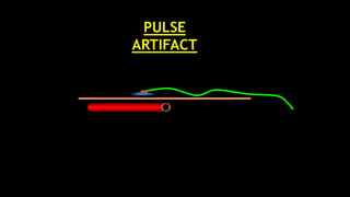 PULSE
ARTIFACT
 