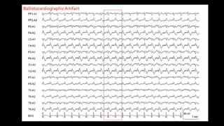 BallistocardiographicArtifact
 