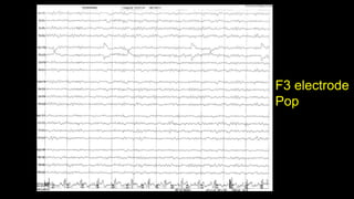 F3 electrode
Pop
 