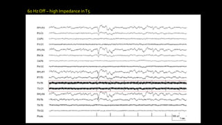 60 Hz Off – high Impedance inT5
 