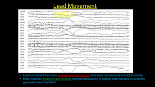  Lead movement has more disorganized morphology that does not resemble true EEG activity
 Often includes double phase reversal (without consistency in polarity that indicates a cerebrally
generated electrical field)
Lead Movement
Artifact
 