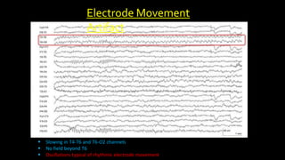 Electrode Movement
Artifact
 Slowing in T4-T6 and T6-O2 channels
 No field beyond T6
 Oscillations typical of rhythmic electrode movement
 
