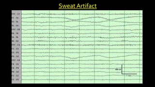 Sweat Artifact
 