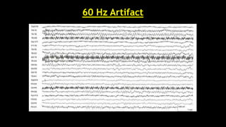 60 Hz Artifact
 