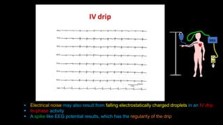 Electrical noise may also result from falling electrostatically charged droplets in an IV drip
 In-phase activity
 A spike like EEG potential results, which has the regularity of the drip
EEG
 