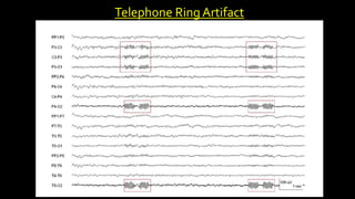Telephone Ring Artifact
 
